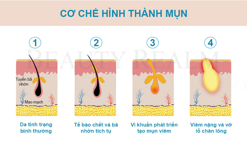 Cơ chế hình thành mụn trứng cá Cơ chế hình thành mụn trứng cá